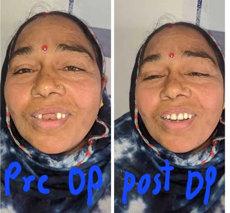 Dant Pratyaropan